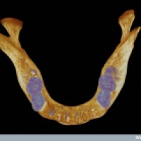 Mandíbula humana medieval (maxilar inferior)